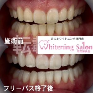 【健康な歯の色】福岡博多/ホワイトニング
