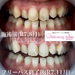 【エナメル質の再生方法とは？】博多/ホワイトニング