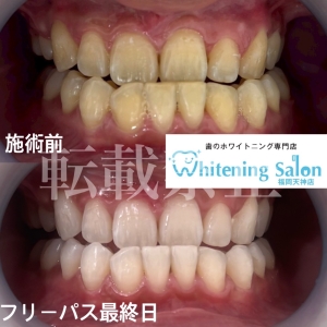 【舌苔（ぜったい）がつきやすい人の特徴】天神/ホワイトニング