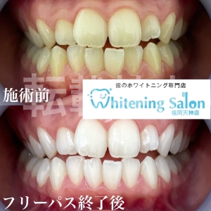 【食べ物で歯は白くなる？】福岡天神/ホワイトニング