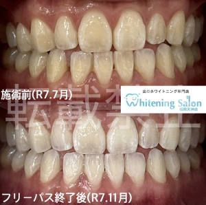 【11月もホワイトニング☆】