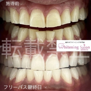 【歯の危険なサイン】福岡博多/ホワイトニング