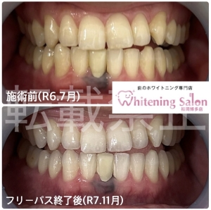 【歯の健康管理】福岡博多/ホワイトニング