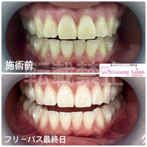 【歯についてのQ &A】福岡博多/ホワイトニング