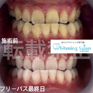 【歯磨きをする際の注意点】福岡天神/ホワイトニング