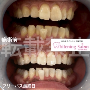 【イベント前に】福岡博多/ホワイトニング