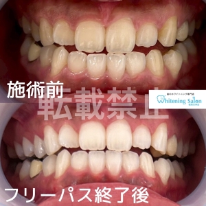 【歯にも栄養】天神/ホワイトニングサロン福岡博多