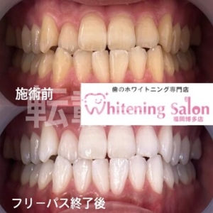 【今年の汚れは今年のうちに！】福岡博多/ホワイトニング