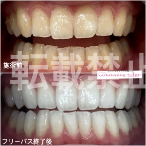 【お年玉キャンペーン!!】福岡博多/ホワイトニング