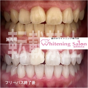 【誰よりも白い歯を目指して☆】福岡博多/ホワイトニング