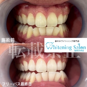 【ホワイトニング可能な歯の種類】天神/ホワイトニング