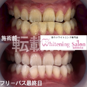 【お手頃な価格で♪】福岡博多/ホワイトニング