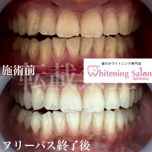 【「だらだら食べ」「ちびちび飲み」はNG】博多/ホワイトニング