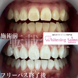 【おえつの原因】福岡/博多/ホワイトニング