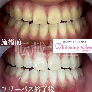 【唾液を増やす工夫を】福岡/博多/ホワイトニング