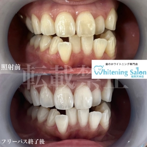 【タフトブラシ】福岡天神/ホワイトニング