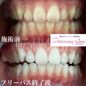 【クリスマスキャンペーン本日までです☆】博多/ホワイトニング