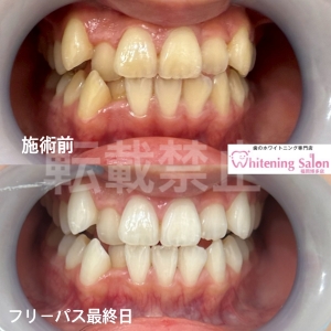 【歯軋りが及ぼす危険とは】博多/ホワイトニング