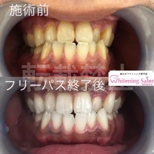 【唇の乾燥】博多/ホワイトニング