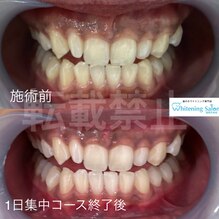 【ホワイトニング後】天神/ホワイトニング