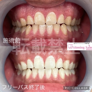 【丈夫な歯】博多/ホワイトニング