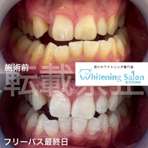 【歯が痛いのはストレス】福岡天神/ホワイトニング