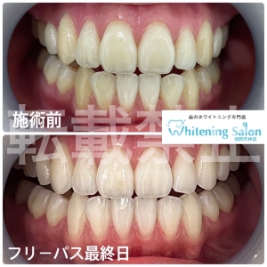 【知覚過敏セルフチェック】福岡天神/ホワイトニング