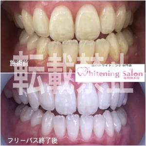 【歯はどんな役割？】福岡博多/ホワイトニング