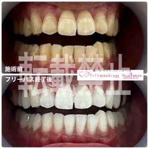 【口腔内のトラブル】福岡博多/ホワイトニング