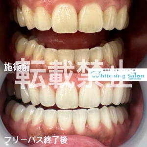 【いびきについて】福岡天神/ホワイトニング