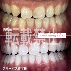 【ホワイトニングを始めよう！】
