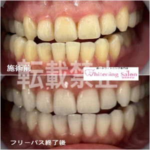 【セルフホワイトニング】福岡博多/ホワイトニング