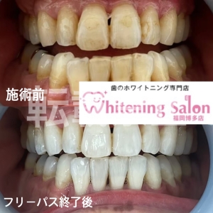 【あけましておめでとうございます】福岡博多/ホワイトニング