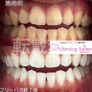 【男性も大歓迎♪】福岡博多/ホワイトニング