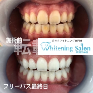 【歯間ブラシの選び方】福岡天神/ホワイトニング