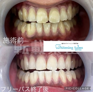 【歯周病と歯肉炎って違うもの！？】福岡/天神/ホワイトニング