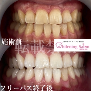 【ホワイトスポットの解決方法】福岡/博多/ホワイトニング