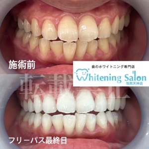 【大人の虫歯になりやすい人】天神/大名/ホワイトニング