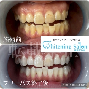 【歯の夢の意味】福岡/天神/大名/ホワイトニング