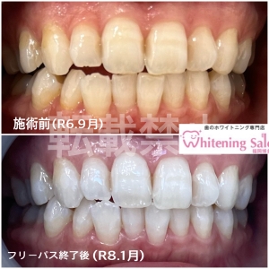 【歯磨き後のうがい】博多