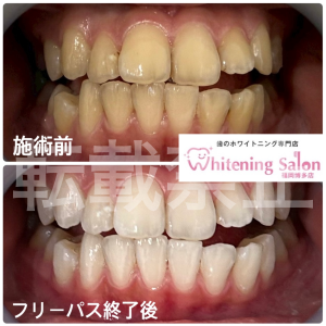 【誰でも簡単にホワイトニング】博多/ホワイトニング