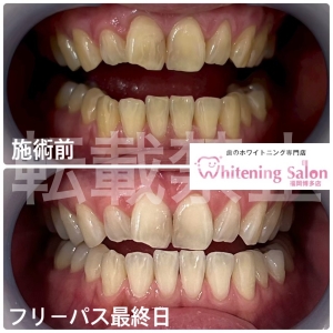 【福岡で通いやすさNo.1】福岡博多/ホワイトニング