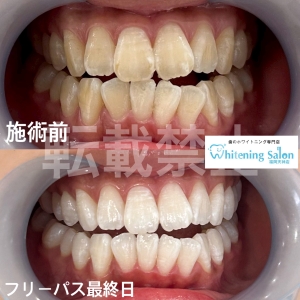 【歯のツヤ】天神/ホワイトニング