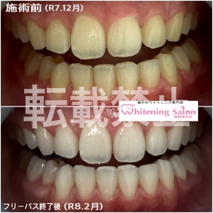 【歯と歯の隙間が変色するのはなぜ？】福岡博多/ホワイトニング