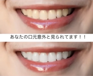 【歯を白くして5歳若返る】福岡天神/ホワイトニング