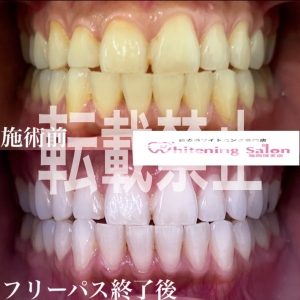 【口臭と虫歯との関係】福岡博多/ホワイトニング