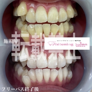 【いびきについて】福岡博多/ホワイトニング