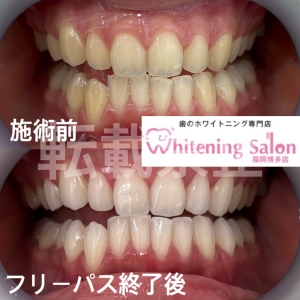 【歯ブラシの保管】福岡博多/ホワイトニング