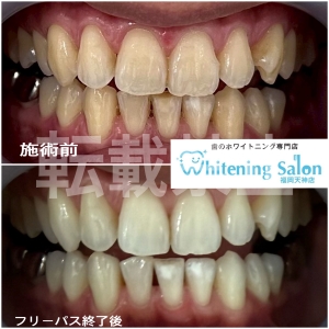 【気圧と歯の痛み】福岡天神/ホワイトニング