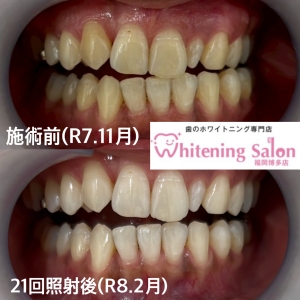 【ホワイトニングの種類】福岡博多/ホワイトニング